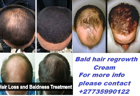 Bald head hair recovery cream +27679005086 USA, UK, Zambia, Namibia, Botswana